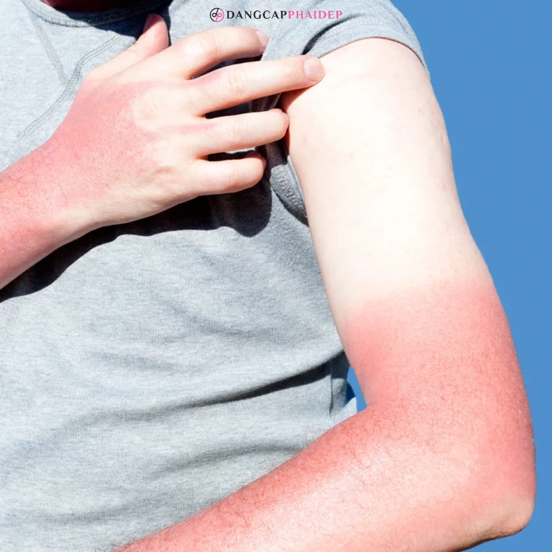 Cháy nắng da tay phải xử lý thế nào?