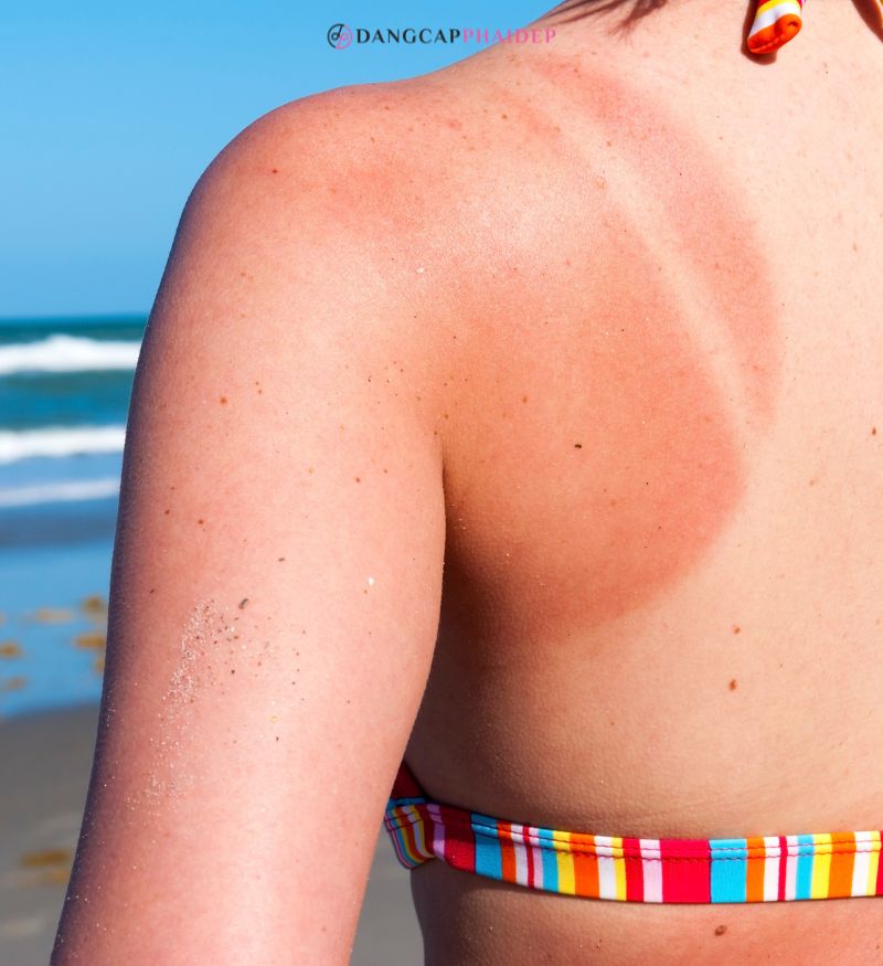 Da bắt nắng là làn da bị bỏng do tiếp xúc lâu dưới ánh nắng mặt trời mạnh.