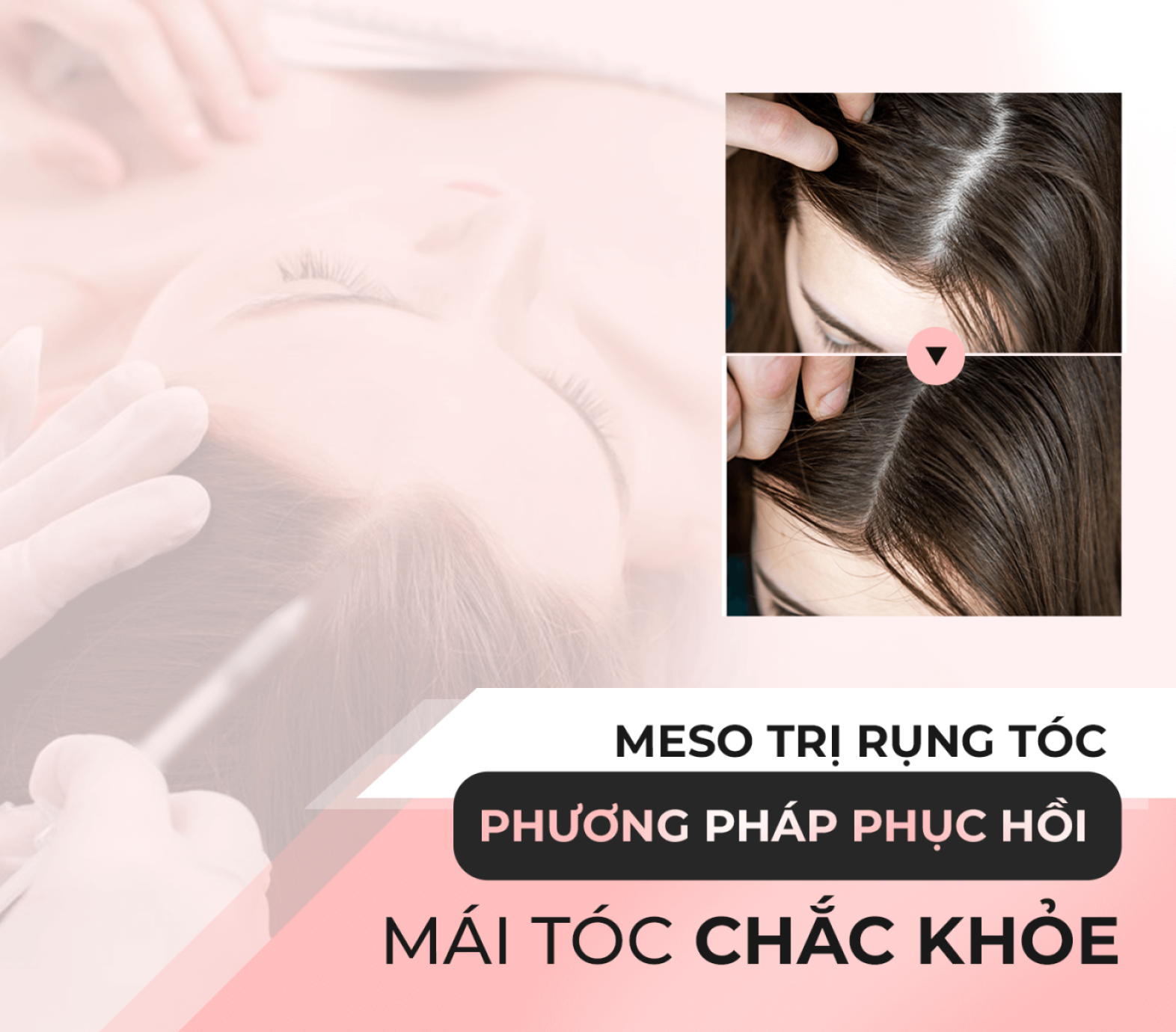 Tiêm meso trị rụng tóc: Bí quyết phục hồi mái tóc chắc khỏe