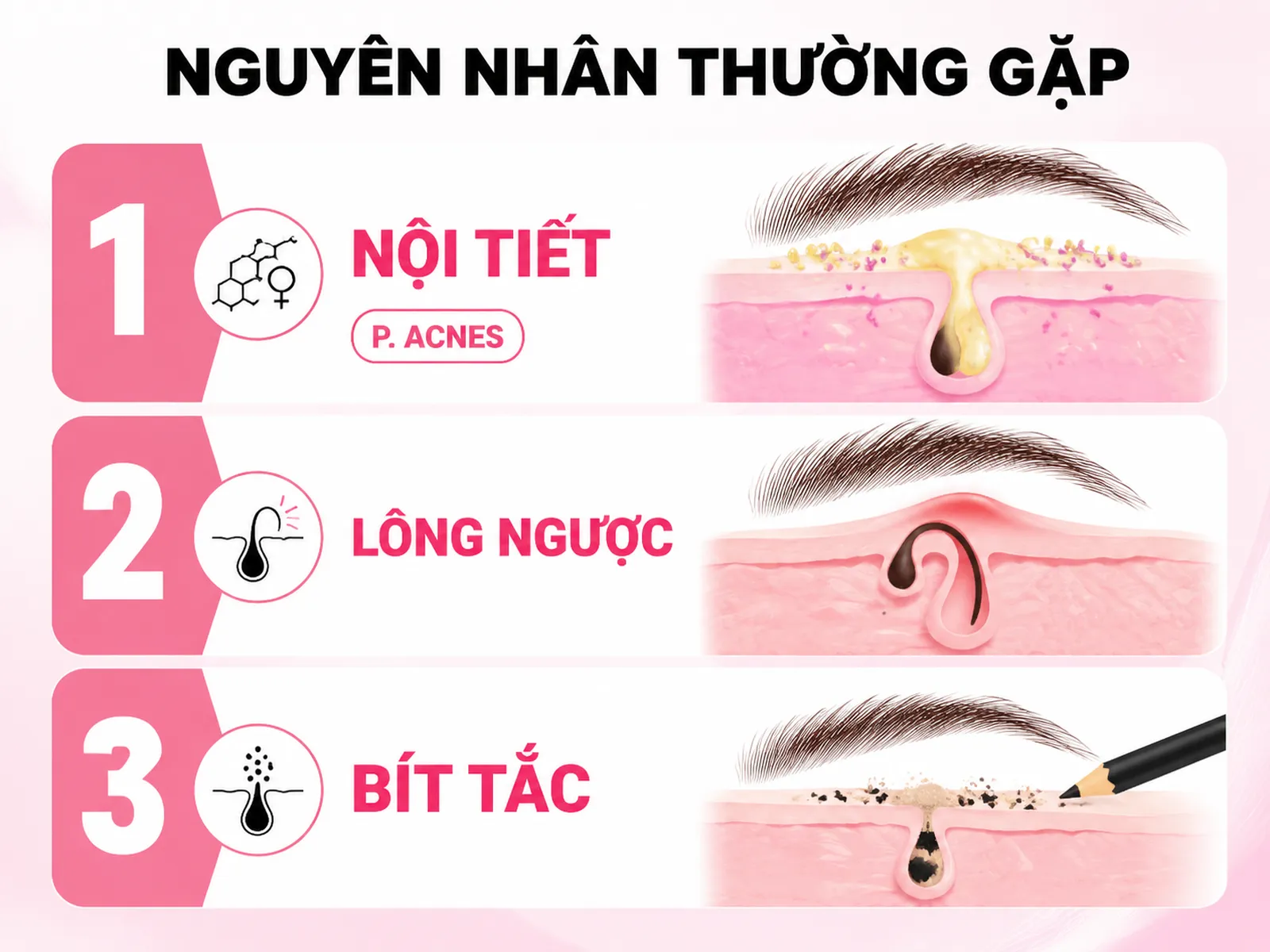 Các nguyên nhân thường gặp gây mụn ở lông mày