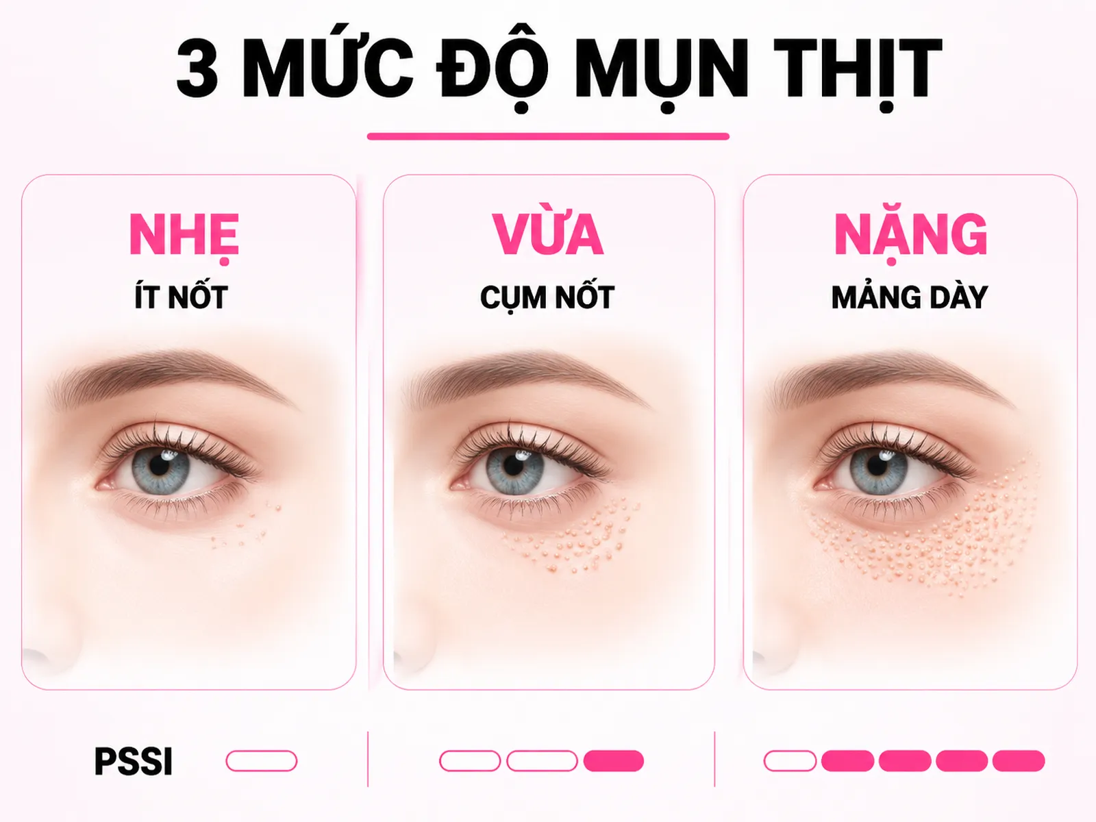 Tự đánh giá mức độ mụn thịt của bạn