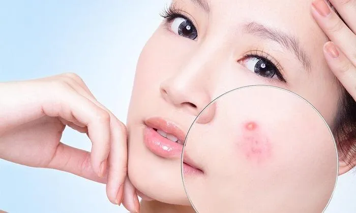 Nước lá khế có giúp đẹp da và giảm mụn không?