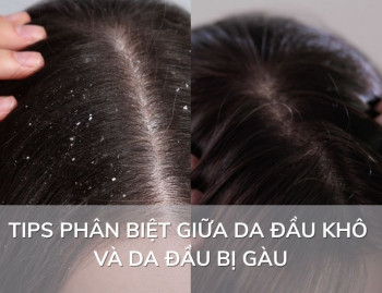 Tips phân biệt giữa da đầu khô và da đầu bị gàu