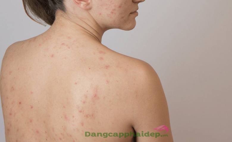 Các loại sản phẩm dưỡng da phổ biến để điều trị mụn ở lưng.
