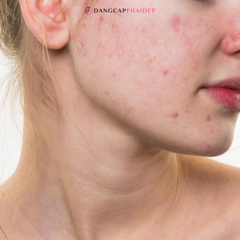 Dù da đang bị mụn thì bạn cũng nên tiếp tục sử dụng kem chống nắng mỗi ngày để bảo vệ da.