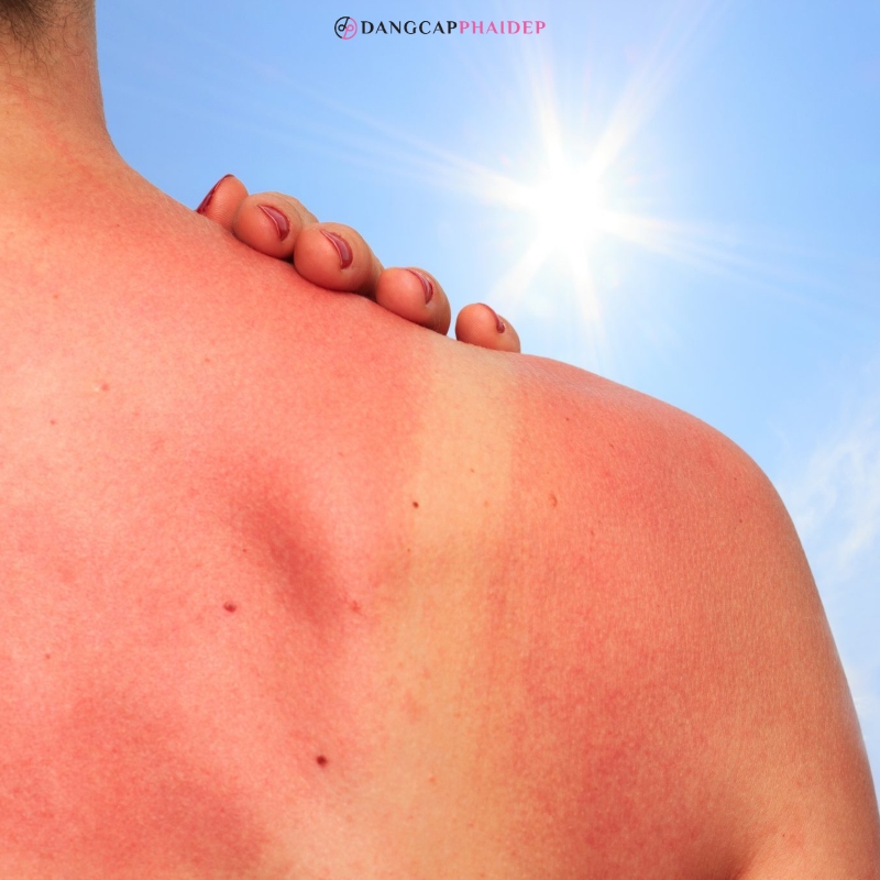 Simptomat e djegies nga dielli janë lehtësisht të dallueshme dhe të dukshme për syrin.