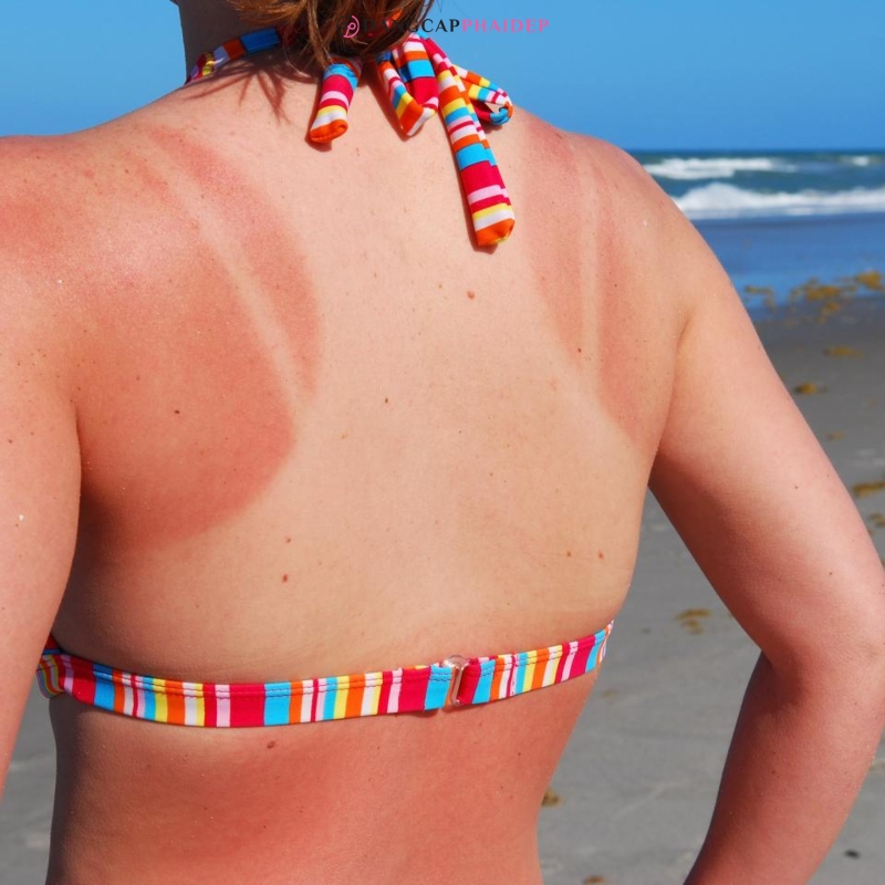 Có nhiều yếu tố ảnh hưởng đến việc phục hồi của da bị cháy nắng.