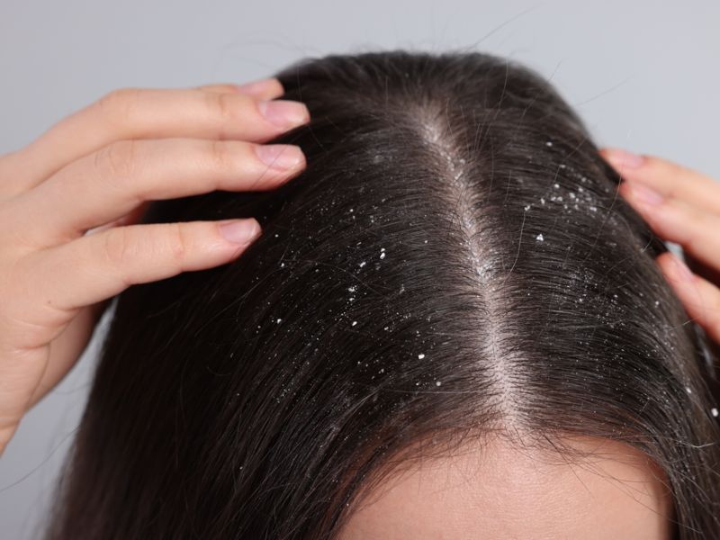 Nguyên nhân gây ra gàu và khô da đầu