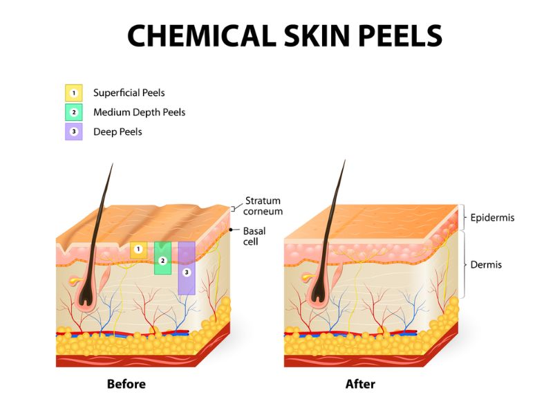  Peel da là gì? Ưu và nhược điểm của phương pháp peel da
