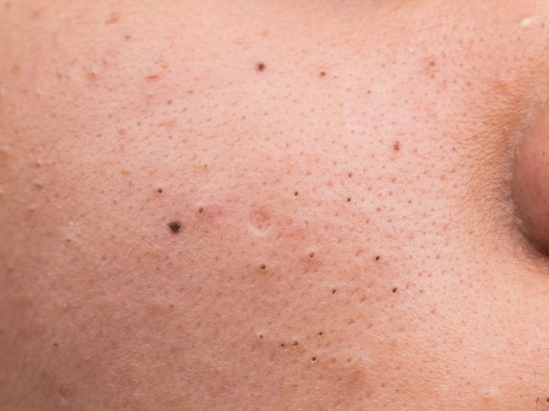 Peel da thích hợp với tình trạng mụn đầu đen, mụn cám và các loại mụn không viêm