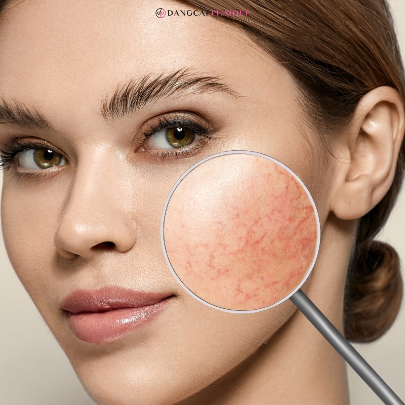 Da mặt sau khi peel sẽ trở nên vô cùng nhạy cảm và rất dễ bị tổn thương.