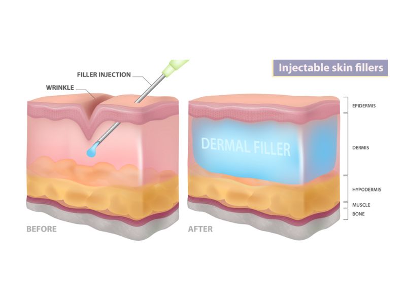 Filler hoạt động dựa trên nguyên lý cung cấp thêm thể tích cho các vùng da cần được cải thiện