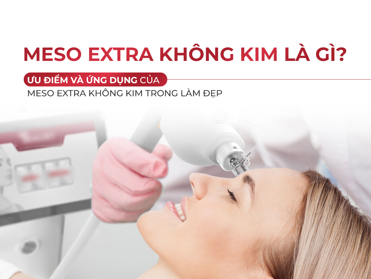 Meso extra không kim là gì?