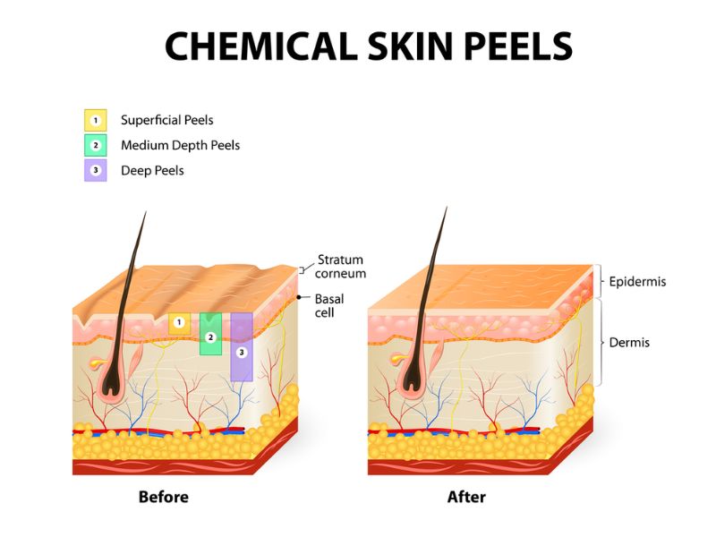 Cơ chế tác động của quá trình peel da