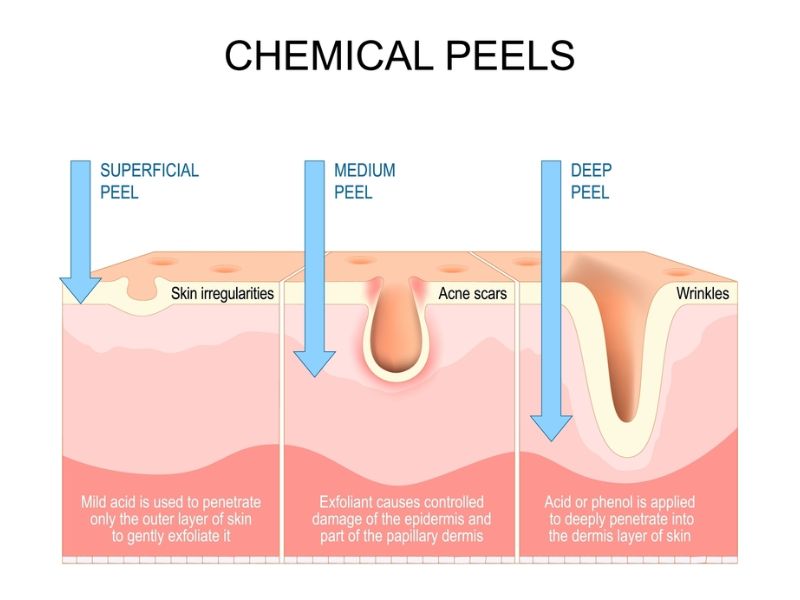 Peel da có 3 cấp độ: peel nông, peel trung bình và peel sâu