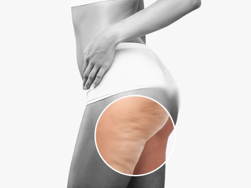 Sần da vỏ cam (Cellulite) là gì?