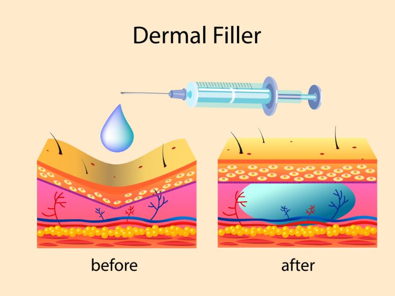 Tiêm filler là một kỹ thuật thẩm mỹ không cần phẫu thuật, sử dụng các chất làm đầy được tiêm trực tiếp dưới da