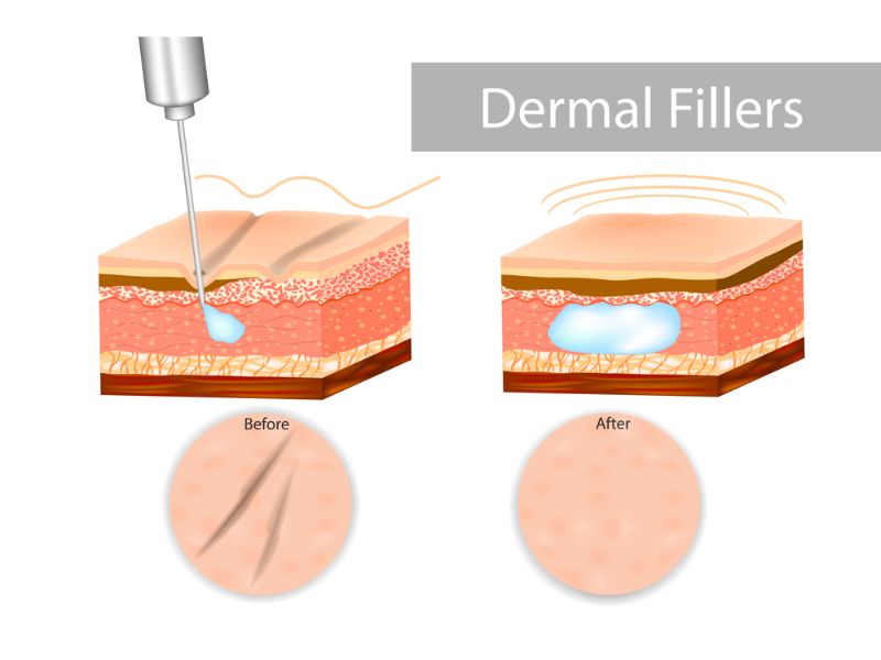  Tiêm filler má là gì? Thông tin cơ bản về tiêm filler má