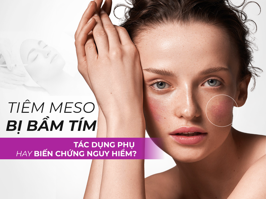 tiêm meso bị bầm tím