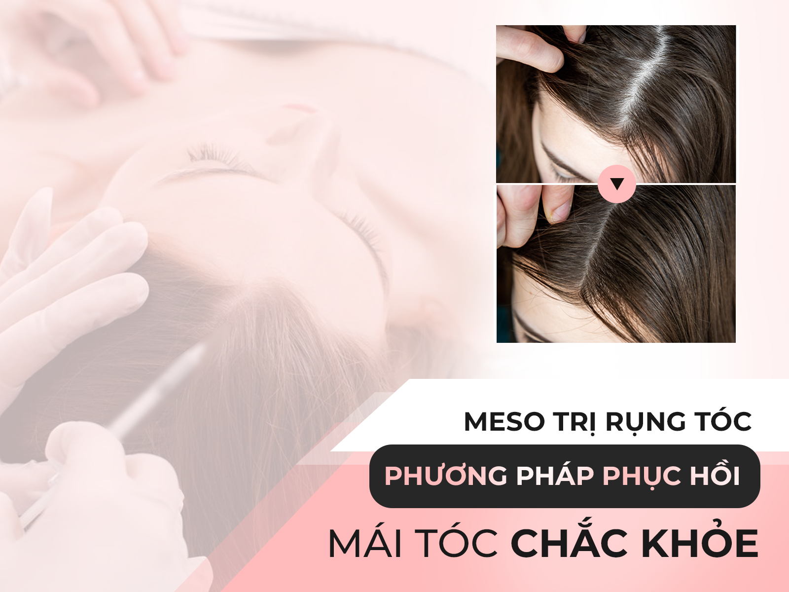 Tiêm meso trị rụng tóc